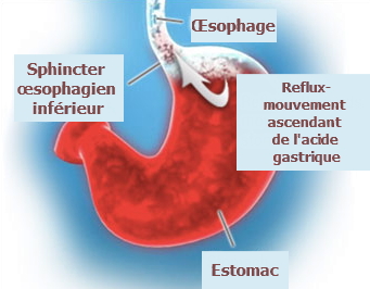 l'oesophage, maladies de l'oesophage, cancer de l'oesophage, mal à l'oesophage, mal à la gorge, le tube digestive, les regurgitations, le RGO, RGO, reflux gastro-oesophagien