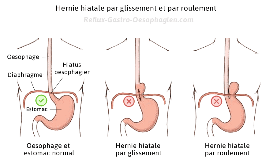 hernie hiatale symptomes