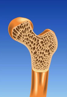 Un os atteint d'ostéoporose osteoporose-os