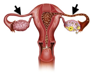 sterilisation-femme