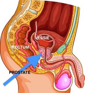 Prostate: adénome et prostatite – Mongeneraliste.be – Votre ...